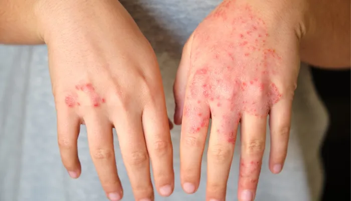 Atopic Dermatitis