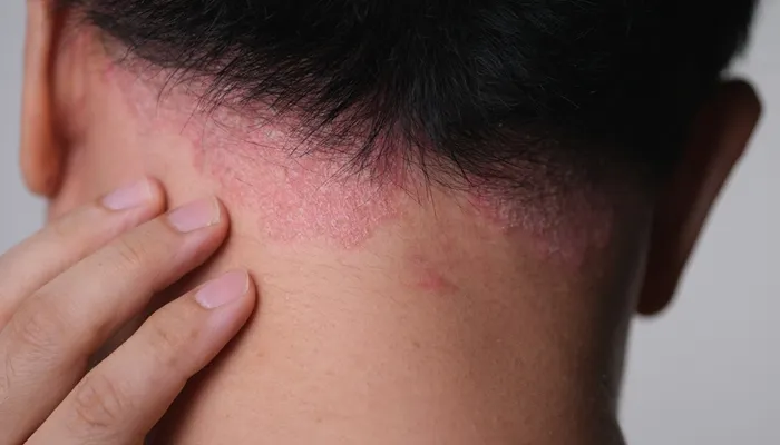 Chronic Itch