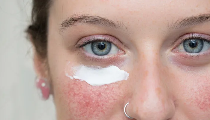Topical Treatments
