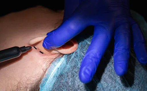 Stretched Ear Lobe Correction
