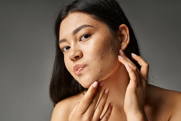 Acne Management